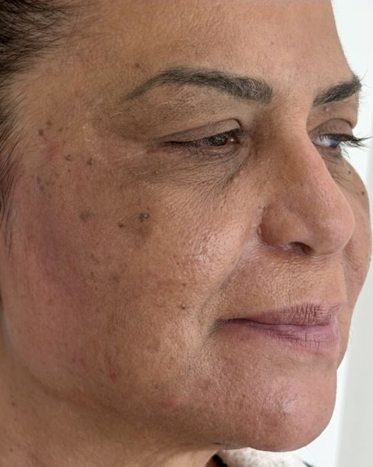 Rosto de paciente depois do procedimento