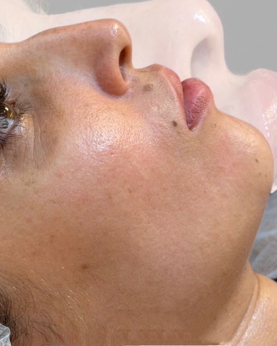 Perfil de paciente antes do preenchimento labial