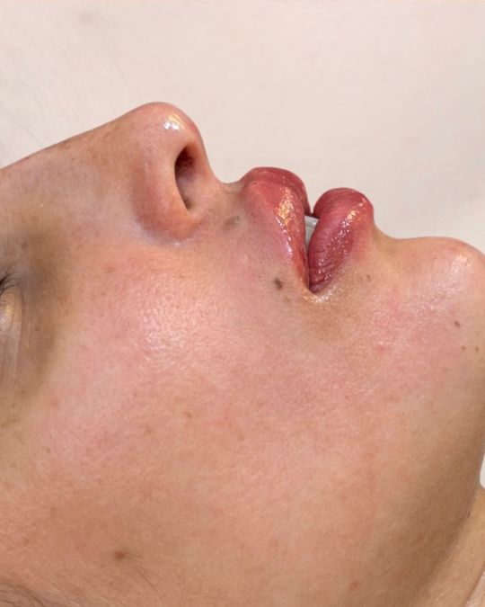 Perfil de paciente depois do preenchimento labial
