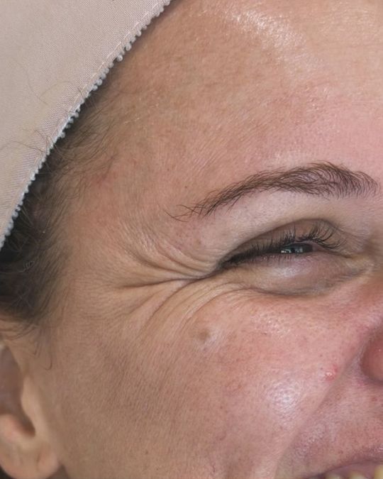 Região dos olhos de paciente antes do procedimento