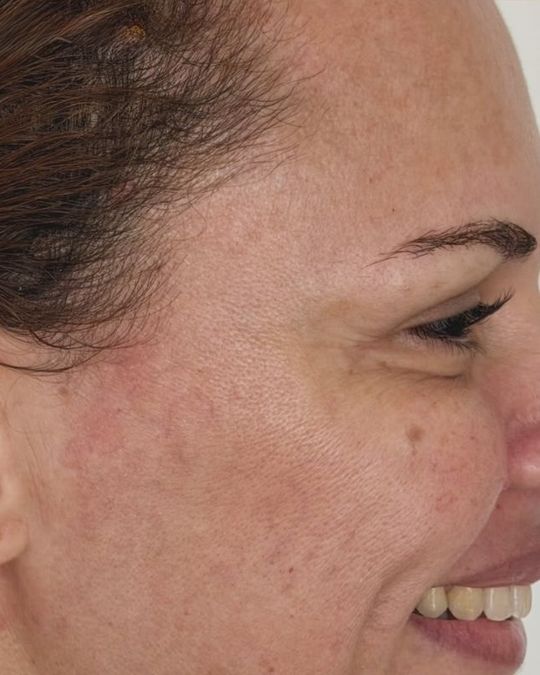 Região dos olhos de paciente depois do procedimento